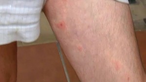 Picaduras de mosca negra.