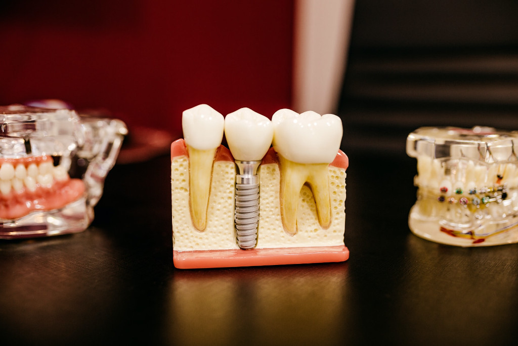 Una maqueta de unos dientes y sus raíces para ejemplificar una noticia sobre la estafa de idental