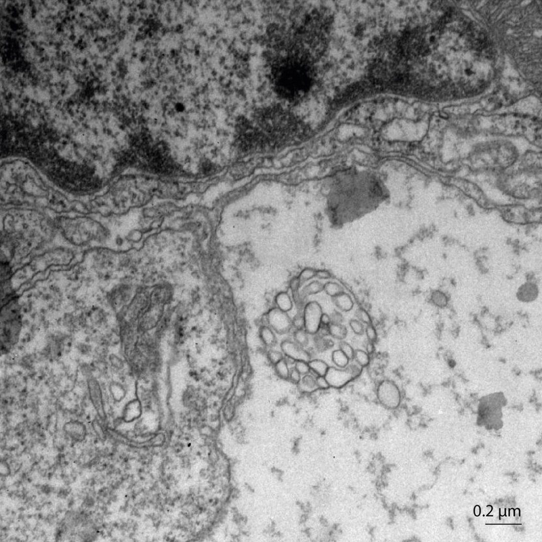 Una investigación aragonesa revela un nuevo mecanismo de comunicación entre células tumorales cerebrales a través de “esferosomas”