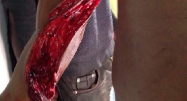 Heridas provocadas por las cuchillas de la valla de Melilla. Foto publicada por 20minutos.es