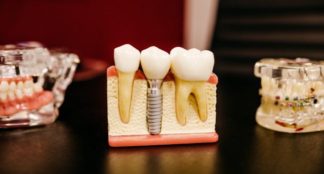 Una maqueta de unos dientes y sus raíces para ejemplificar una noticia sobre la estafa de idental