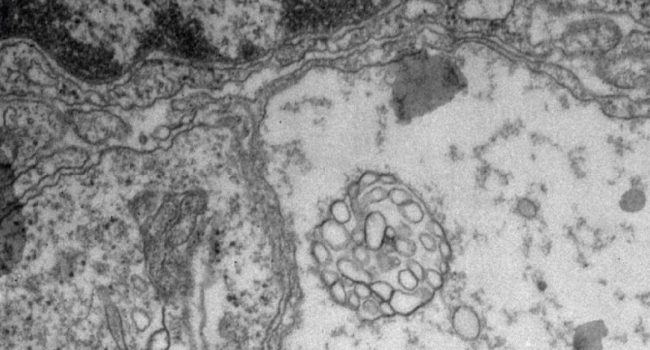 Una investigación aragonesa revela un nuevo mecanismo de comunicación entre células tumorales cerebrales a través de “esferosomas”